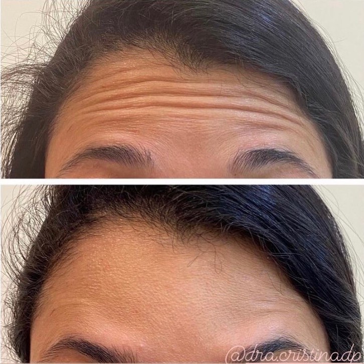 botox