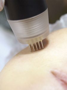 radiofrecuencia fraccionada