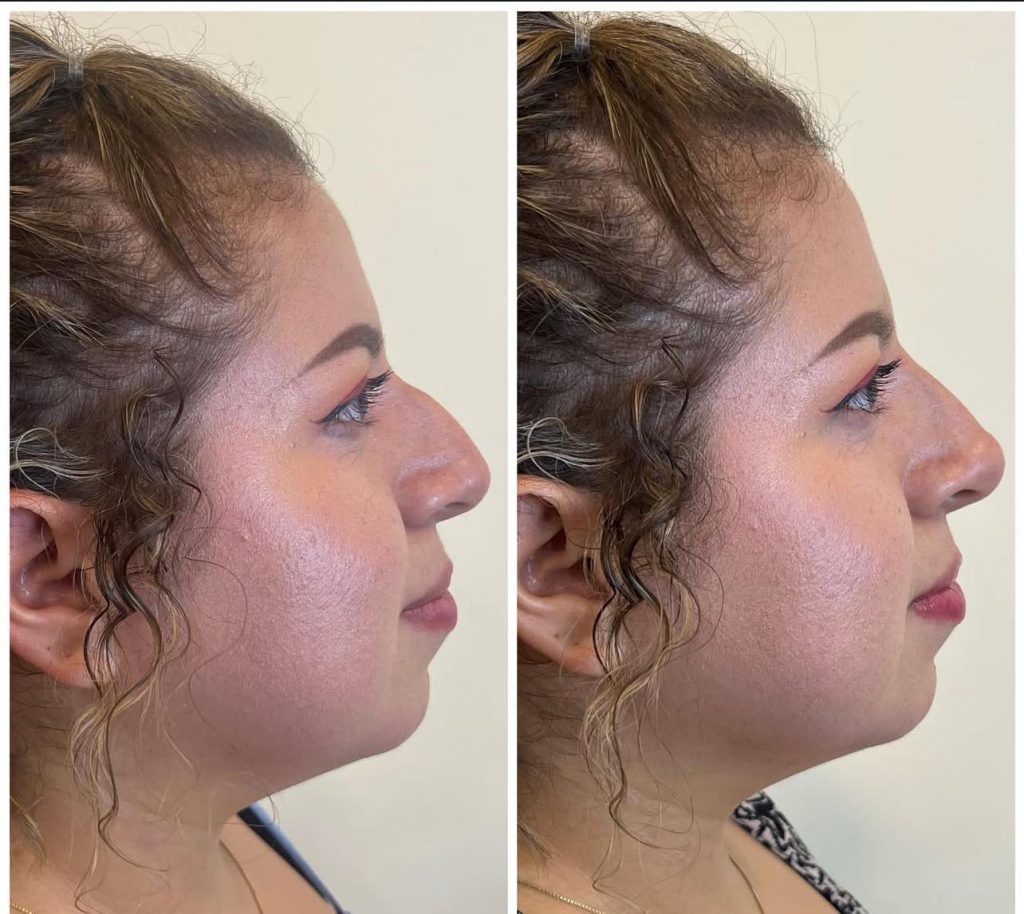 rinoplastia