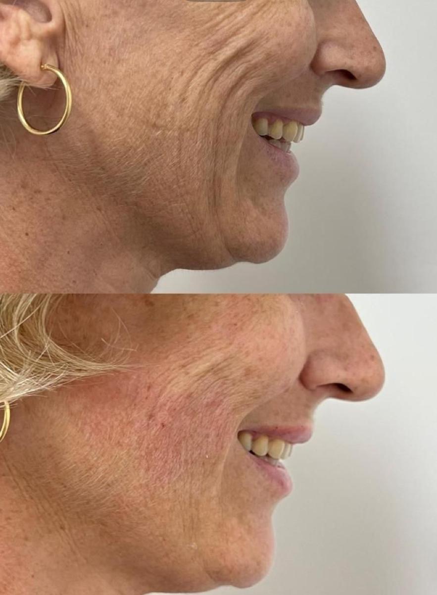 El rostro después de una gran pérdida de peso: cómo acompañarlo correctamente